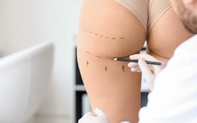 Comment savoir quand on est prête pour une liposuccion ?